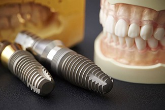 dentures and implants