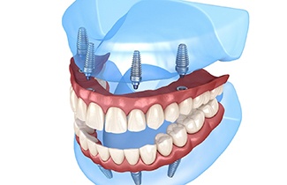 Illustration of All-on-4 for both upper and lower arch