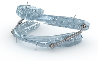 Close-up of sleep apnea oral appliance