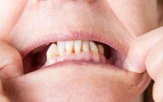 A close-up of a mouth with missing teeth