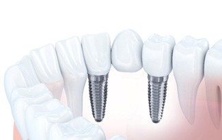 A 3D illustration of a dental implant bridge