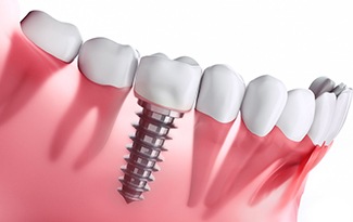 Diagram of dental implants in Lincoln