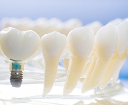 Model of dental implants in Lincoln in jawbone