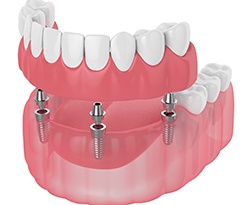Digital illustration for implant dentures