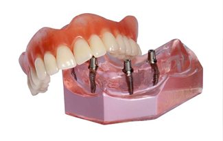 Model of implant retained denture