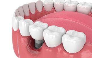 Render of a failed dental implant in Lincoln, NE