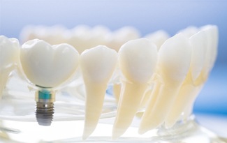 Model of dental implant