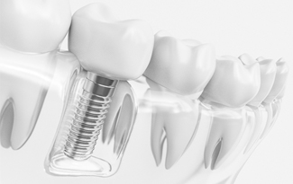 Single tooth implant