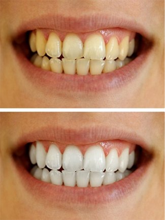 Before and after teeth whitening