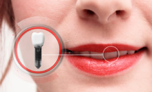 Dental implant graphic